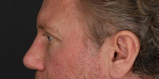 Blepharoplasty Before & After Gallery - Patient 713572 - Image 6