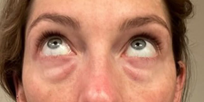 Blepharoplasty Before & After Gallery - Patient 583871 - Image 3