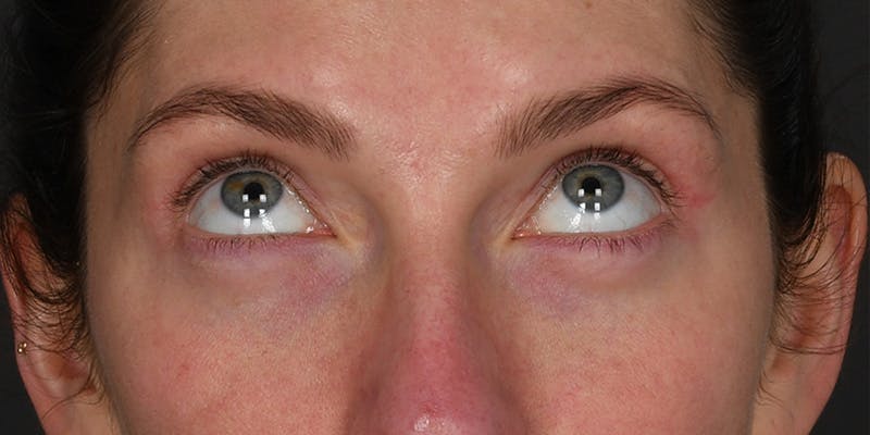 Blepharoplasty Before & After Gallery - Patient 583871 - Image 4