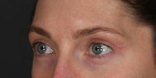 Blepharoplasty Before & After Gallery - Patient 583871 - Image 6