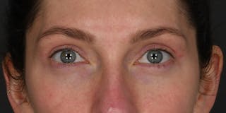 Blepharoplasty Before & After Gallery - Patient 583871 - Image 2