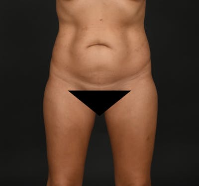 Tummy Tuck Before & After Gallery - Patient 416220 - Image 1