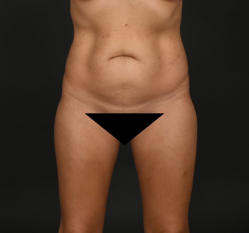 Tummy Tuck Before & After Gallery - Patient 416220 - Image 1