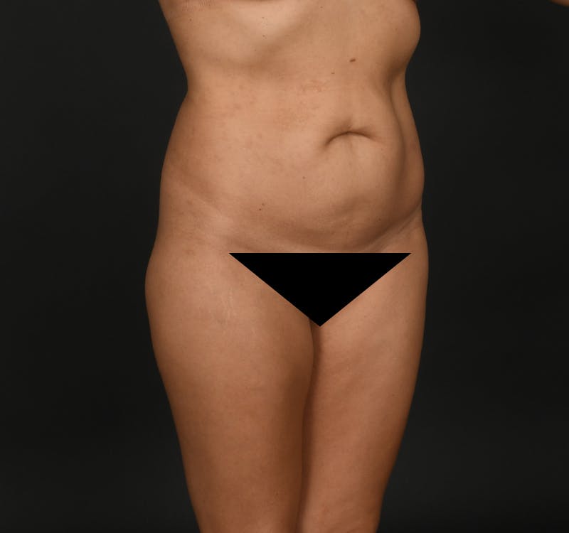Tummy Tuck Before & After Gallery - Patient 416220 - Image 3