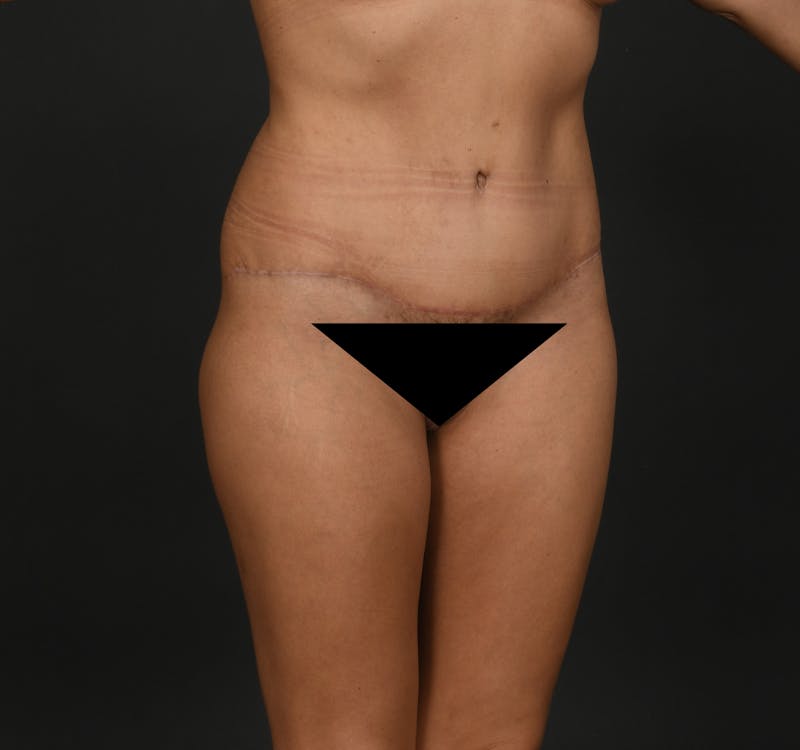Tummy Tuck Before & After Gallery - Patient 416220 - Image 4
