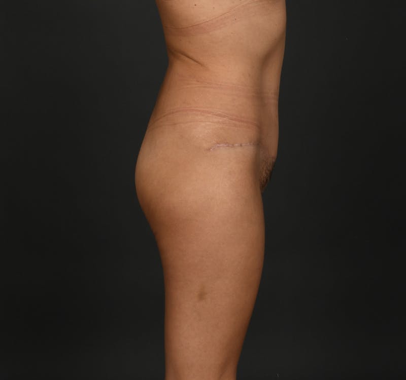 Tummy Tuck Before & After Gallery - Patient 416220 - Image 6