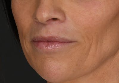 Lip Lift Before & After Gallery - Patient 120983 - Image 2
