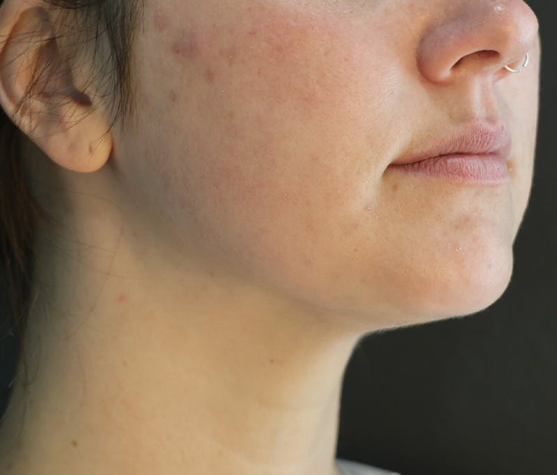 Submental Liposuction Before & After Gallery - Patient 416433 - Image 2