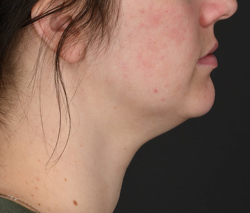 Submental Liposuction Before & After Gallery - Patient 416433 - Image 3