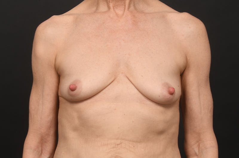 Breast Augmentation Before & After Gallery - Patient 417723 - Image 1