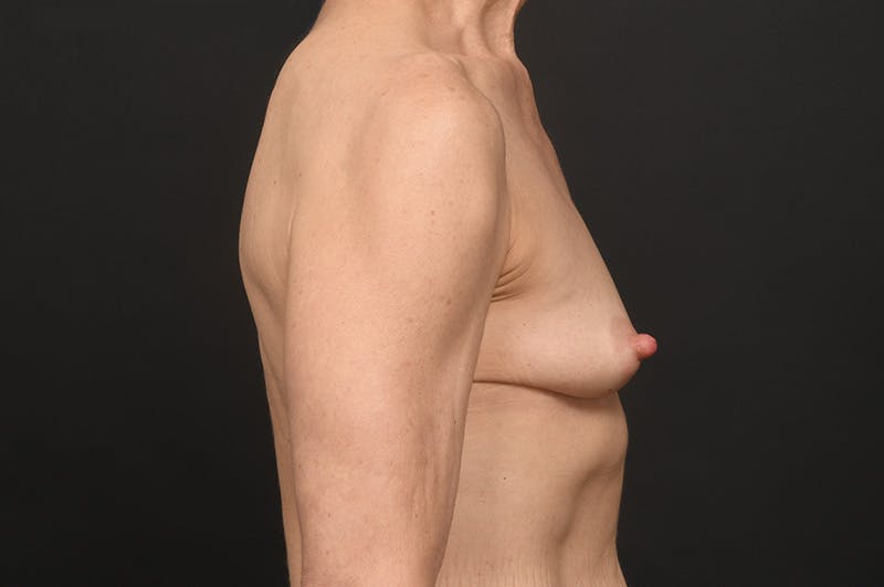 Breast Augmentation Before & After Gallery - Patient 417723 - Image 3