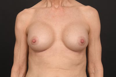 Breast Augmentation Before & After Gallery - Patient 417723 - Image 2