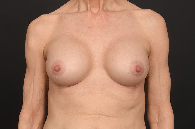 Breast Augmentation Before & After Gallery - Patient 417723 - Image 2