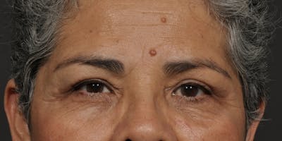 Blepharoplasty Before & After Gallery - Patient 164603 - Image 2