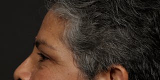 Blepharoplasty Before & After Gallery - Patient 164603 - Image 6