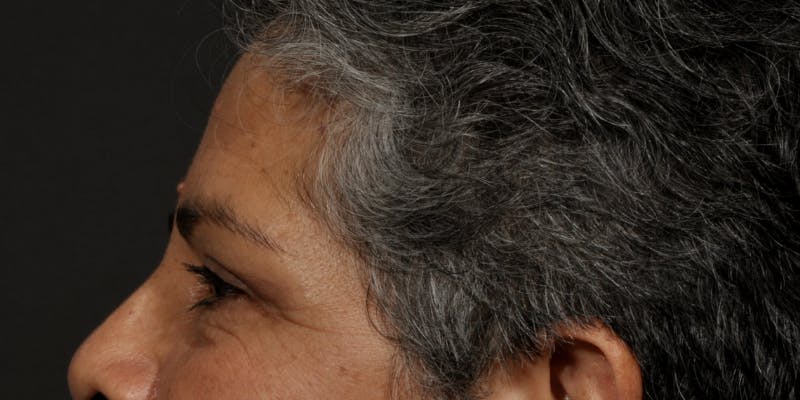 Blepharoplasty Before & After Gallery - Patient 164603 - Image 6