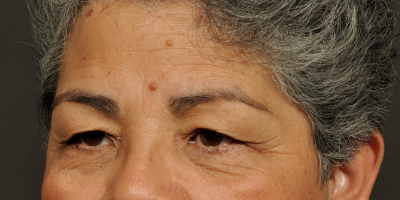 Blepharoplasty Before & After Gallery - Patient 164603 - Image 3