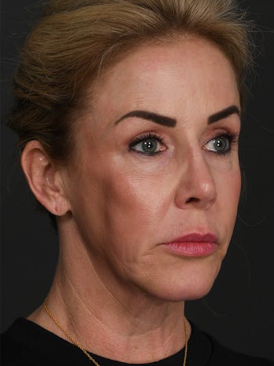Facelift Before & After Gallery - Patient 428280 - Image 1