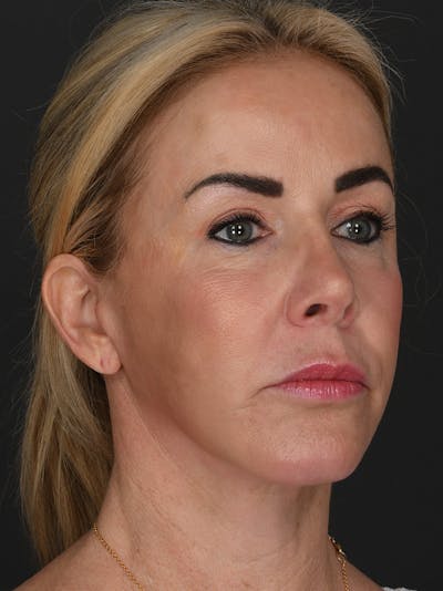 Facelift Before & After Gallery - Patient 428280 - Image 2