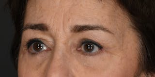 Blepharoplasty Before & After Gallery - Patient 164603 - Image 4