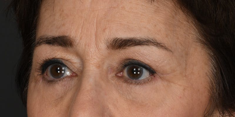 Blepharoplasty Before & After Gallery - Patient 164603 - Image 4