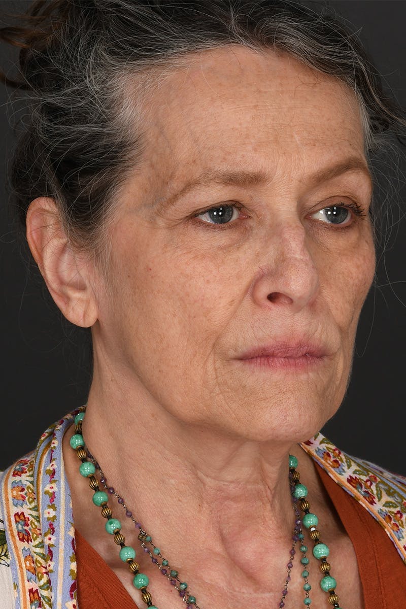 Rhinoplasty Before & After Gallery - Patient 688600 - Image 3