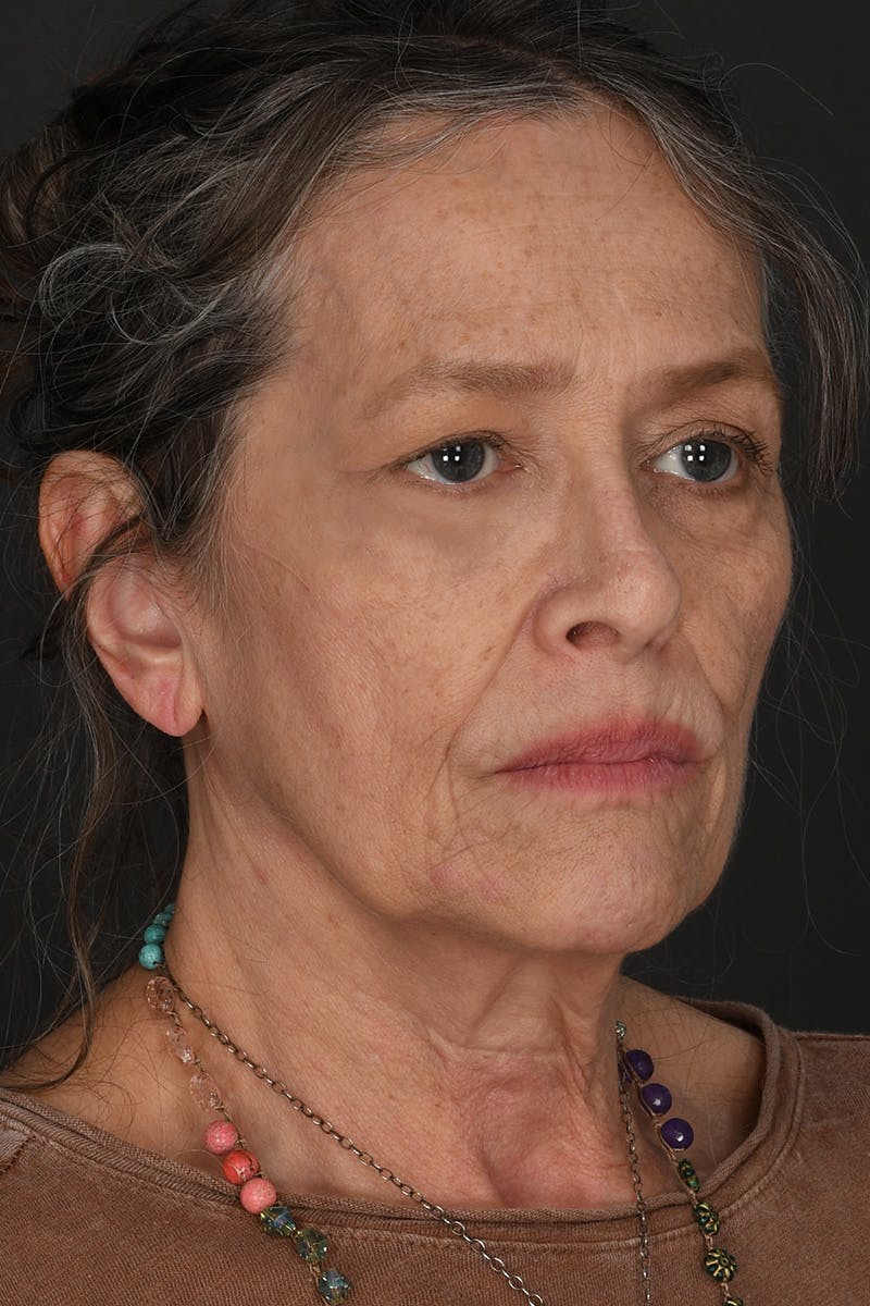 Rhinoplasty Before & After Gallery - Patient 688600 - Image 4