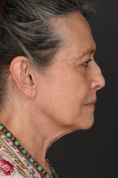 Rhinoplasty Before & After Gallery - Patient 688600 - Image 1
