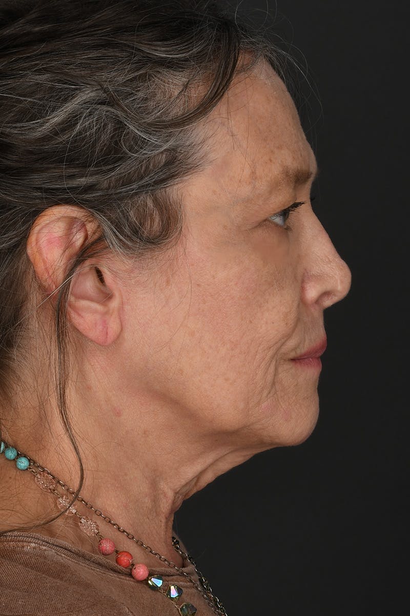 Rhinoplasty Before & After Gallery - Patient 688600 - Image 2