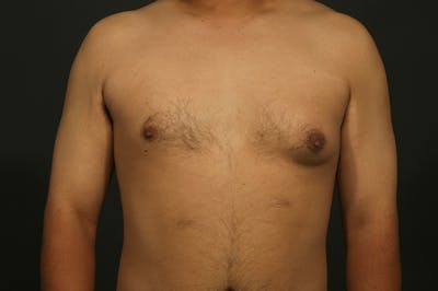 Male Gynecomastia Correction Before & After Gallery - Patient 422220 - Image 1