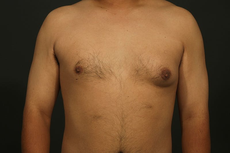 Male Gynecomastia Correction Before & After Gallery - Patient 422220 - Image 1
