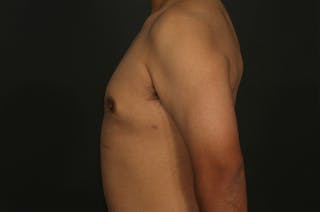 Male Gynecomastia Correction Before & After Gallery - Patient 422220 - Image 6