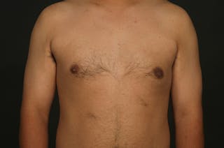 Male Gynecomastia Correction Before & After Gallery - Patient 422220 - Image 2