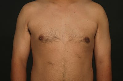 Male Gynecomastia Correction Before & After Gallery - Patient 422220 - Image 2