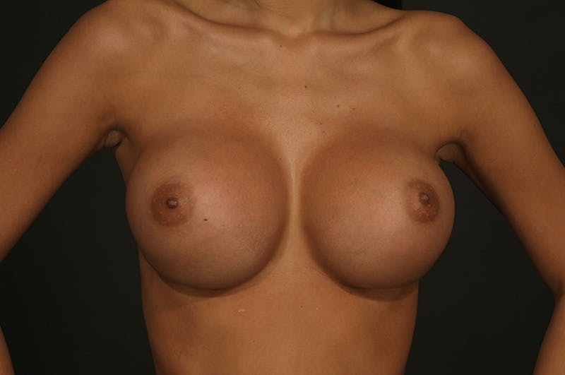 Breast Augmentation Before & After Gallery - Patient 340655 - Image 2
