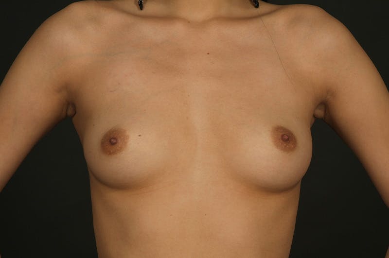 Breast Augmentation Before & After Gallery - Patient 340655 - Image 1