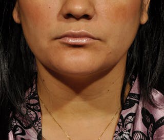 Submental Liposuction Before & After Gallery - Patient 396132 - Image 2