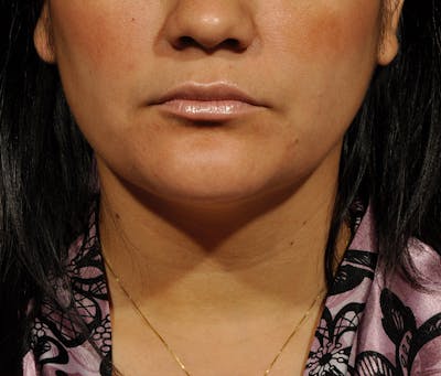 Submental Liposuction Before & After Gallery - Patient 396132 - Image 2