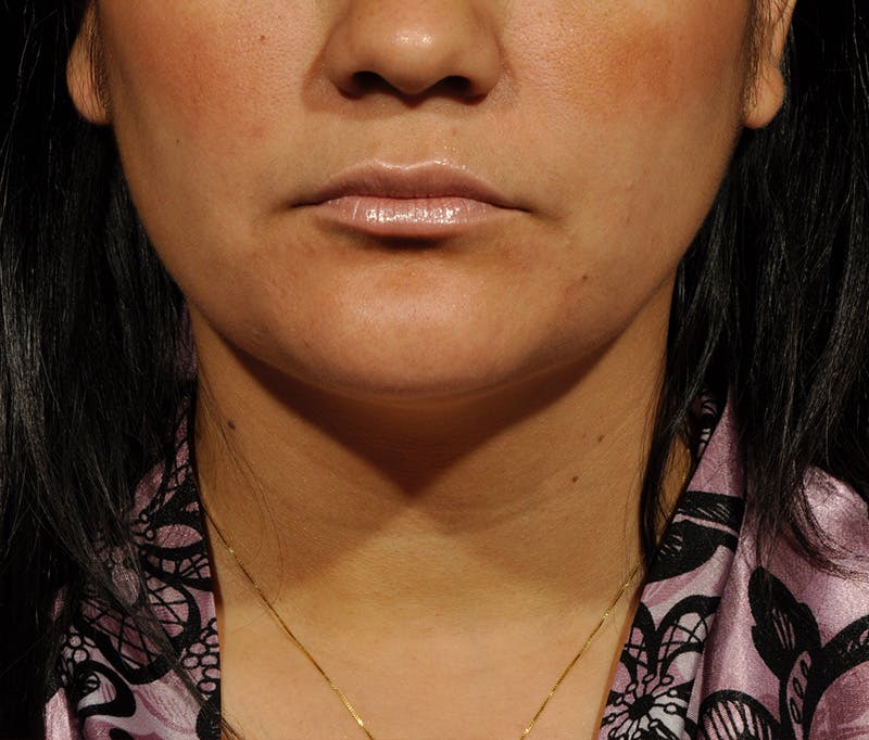 Submental Liposuction Before & After Gallery - Patient 396132 - Image 2