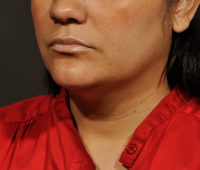 Submental Liposuction Before & After Gallery - Patient 396132 - Image 3