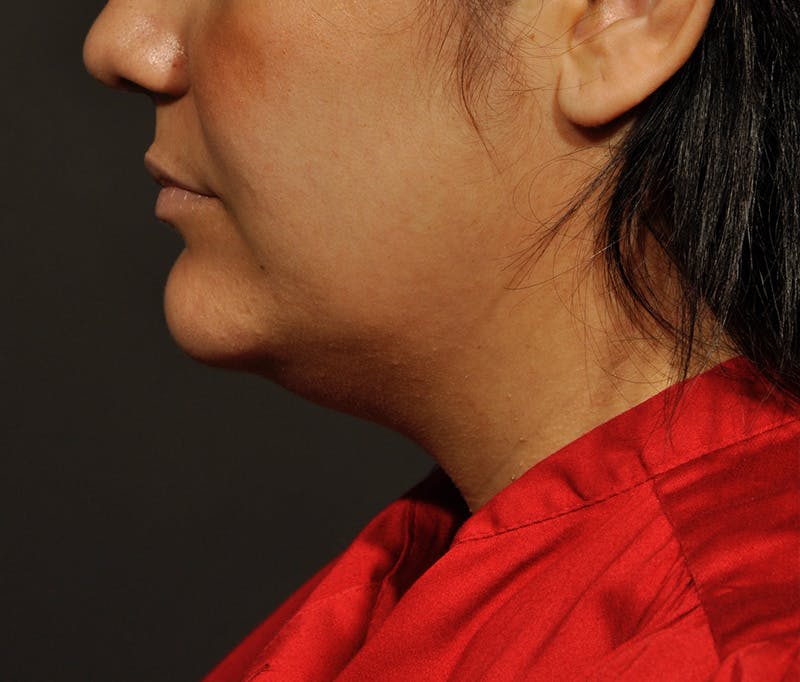 Submental Liposuction Before & After Gallery - Patient 396132 - Image 5