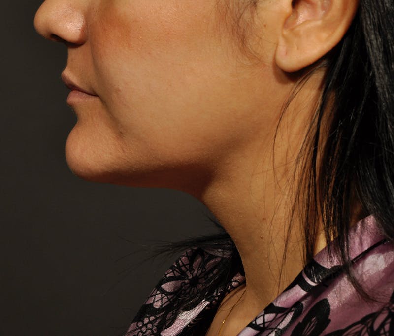 Submental Liposuction Before & After Gallery - Patient 396132 - Image 6