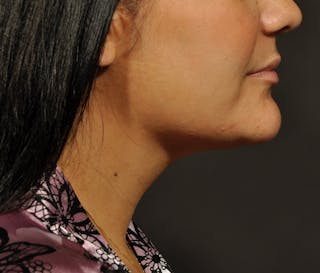 Submental Liposuction Before & After Gallery - Patient 396132 - Image 8