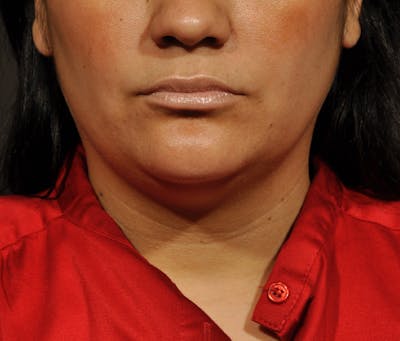 Submental Liposuction Before & After Gallery - Patient 396132 - Image 1