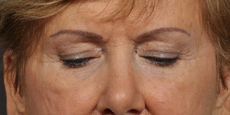 Brow Lift Before & After Gallery - Patient 387702 - Image 3