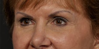 Brow Lift Before & After Gallery - Patient 387702 - Image 6
