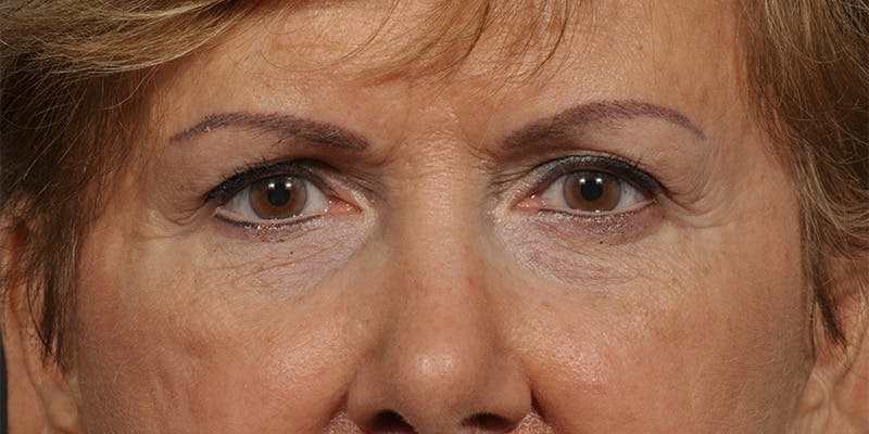 Brow Lift Before & After Gallery - Patient 387702 - Image 1