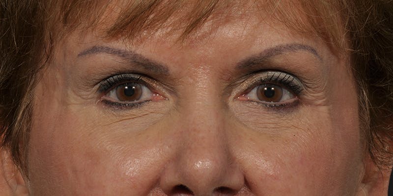 Brow Lift Before & After Gallery - Patient 387702 - Image 2