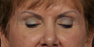 Brow Lift Before & After Gallery - Patient 387702 - Image 4