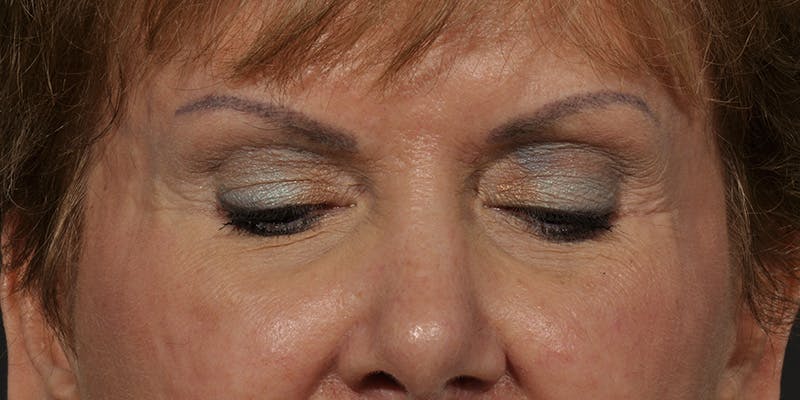 Brow Lift Before & After Gallery - Patient 387702 - Image 4